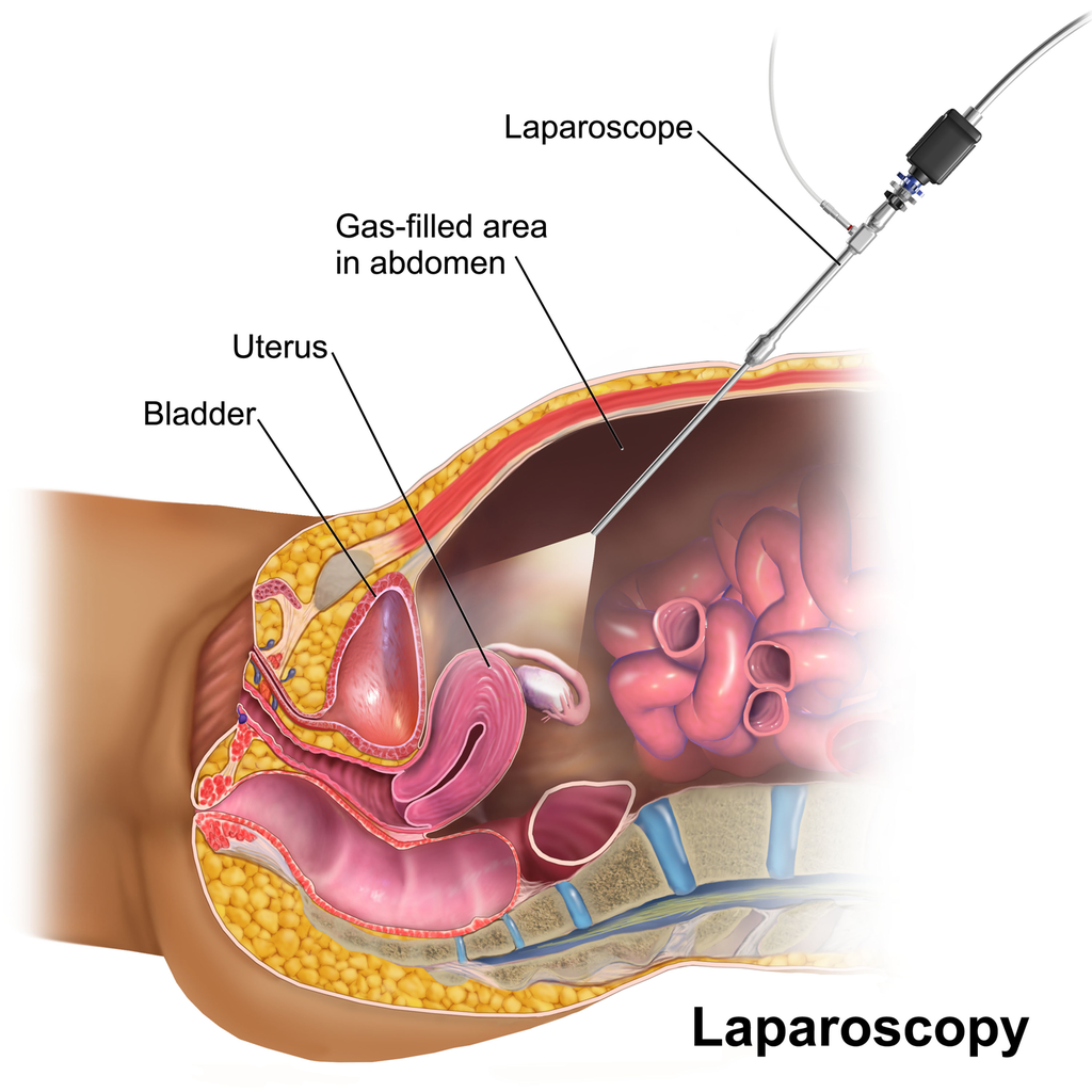 Ilustração de cirurgia laparoscópica