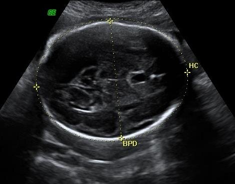 Perímetro cefálico em ecografia