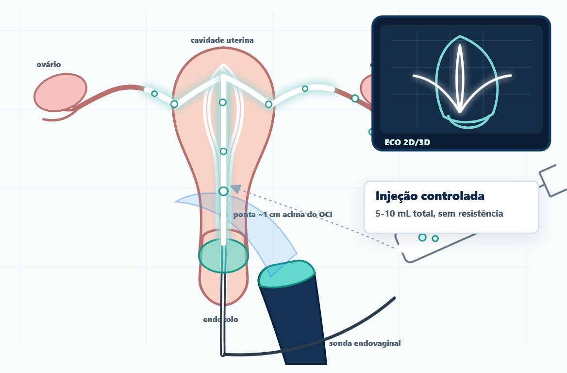 HyFoSy — avaliação ecográfica da permeabilidade tubária